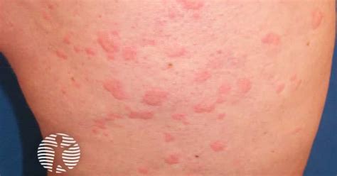 dermnet|dermnet urticaria.